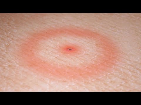Lyme Disease: Symptoms, Treatments, and Ways to Avoid Getting a Deer Tick Bite