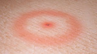Lyme Disease: Symptoms and Treatments