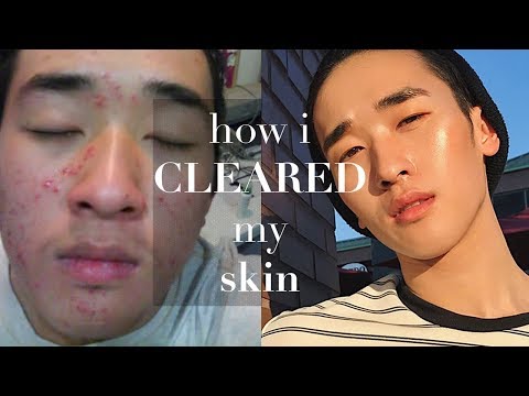 STEPS TO CLEAR SKIN | TIPS for ACNE PRONE SKIN