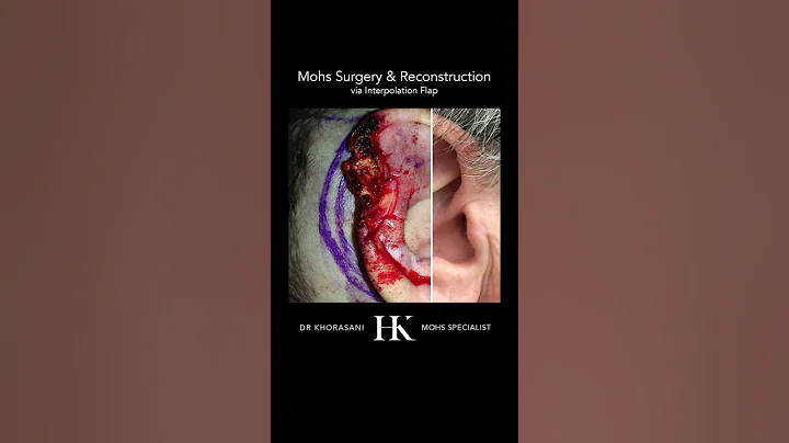 Scar Revision after Mohs Surgery on the ear using Interpolation closure | Dr. Hooman Khorasani | NYC