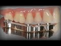 How To Make A Hybrid Acrylic Partial with Attachment - The Entire Process | Dental Lab Learning