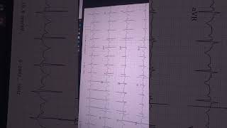 Ecg : sinus tachycardia left posterior hemibloc abnormally long QT interval