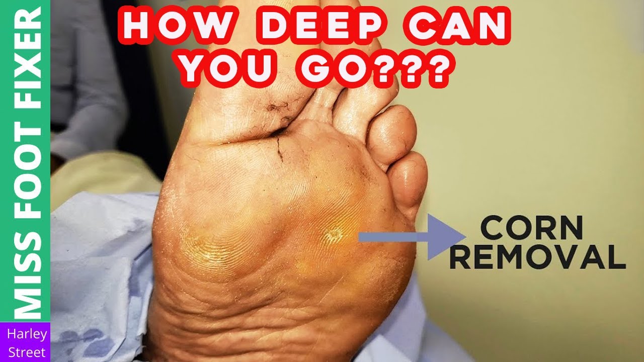 HOW DEEP CAN YOU GO ??? FOOT CORN REMOVAL BY MISS Foot Fixer Marion Yau