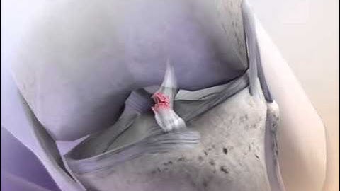 ACL Tear: Learn@Visible Body