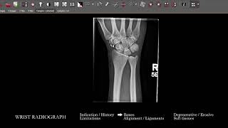 Famous [XR] Wrist Radiograph | Search Pattern Wealth