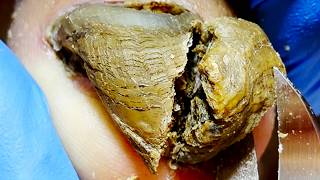 There Are So Many Surprises Under The Toenails, Professional Pedicure【Xue Yidao】