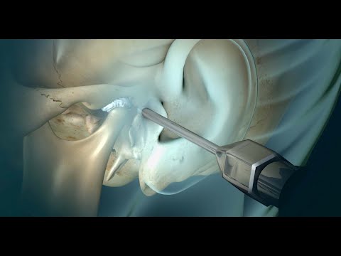 Surgery for TMJ Pain (headaches, earaches, popping noise)