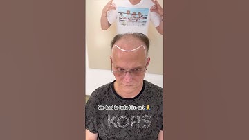 Life-changing hair loss transformation 🤯 #scalpmicropigmentation #hairtattoo #hairloss