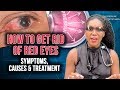 How To Get Rid Of Red Eyes Top 5 Causes 2020 