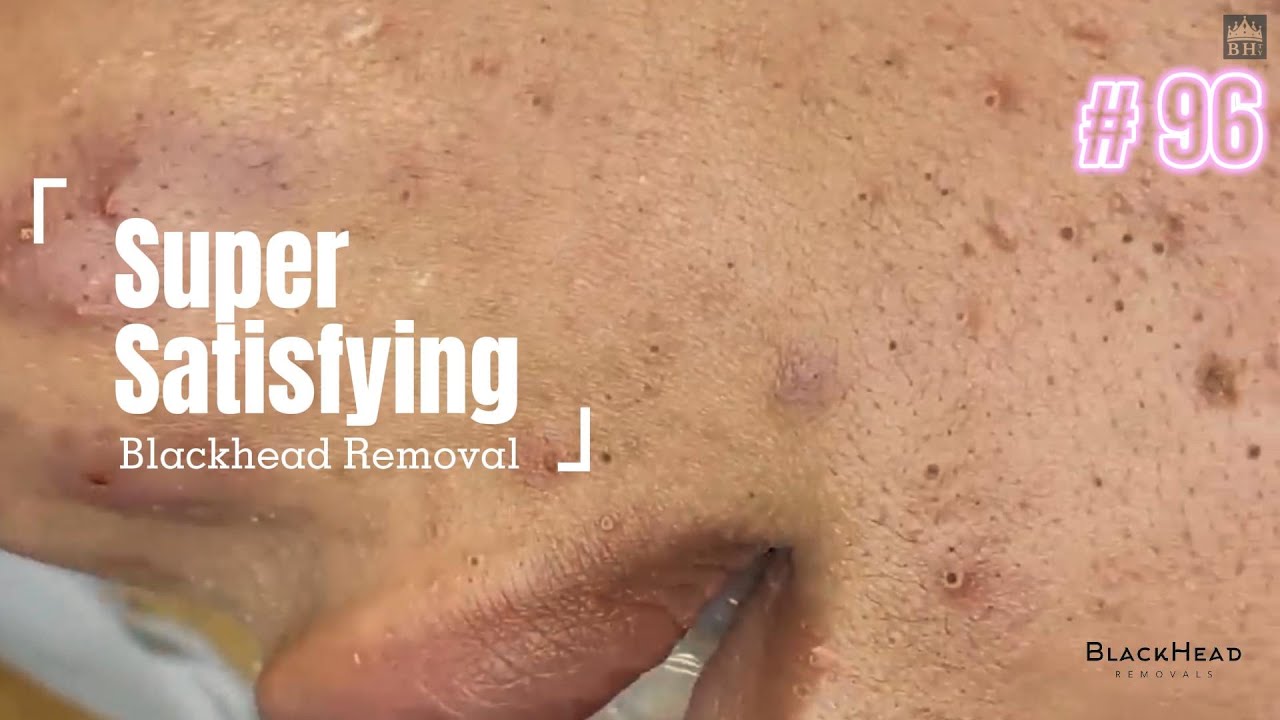 Super Satisfying BLACKHEAD REMOVAL - YouTube