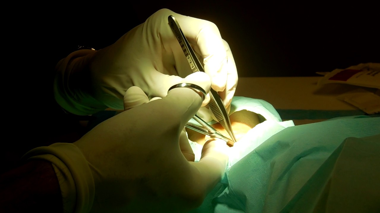 Wrist pin/Kwire removal (Action is at 4 and 19 minutes) 170621 YouTube