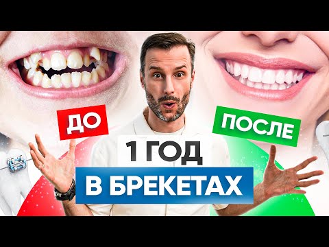 Брекеты До и После – 5 реальных примеров сложных работ в клинике OrthoLike