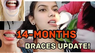 Braces update/Gap filling / 14-months braces tightening#howto#braces#teeth#bracespain