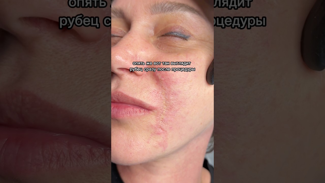 Шлифовка рубцов-самый действенный способ👌🏻Ставь + и отправлю полное видео процедуры⬇️ 