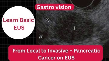 How to Identify Pancreatic Cancer and Vascular Invasion on EUS