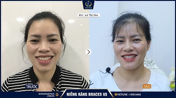 Ai nói trên 30 tuổi không niềng được răng ?