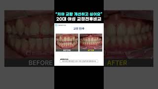 &quot;치아 교합 개선하고 싶어요&quot; 20대 여성 교정전후비교