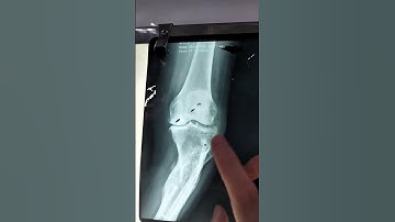 Biến dạng nặng cẳng chân hơn 10 năm sau phẫu thuật gãy xương #bacsithoan #chanthuongchinhhinh