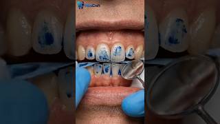 Bite Correction Transformation – Uneven bite adjusted for perfect alignment #shorts #asmr #dentist