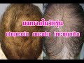 คุยกับ นพ.สมนึก อมรสิริพาณิชย์ เรื่องผมบางในวัยรุ่น (alopecia areata incognita)