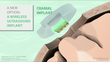 Implantable Cranial Ultrasound Sensor for Post-Operative Monitoring of Brain Tumor Regrowth