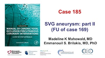 Case 185: Manual of CTO PCI - How to occlude aneurysmal SVGs