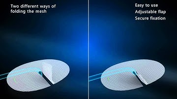 Self Fixating Mesh  Technolog