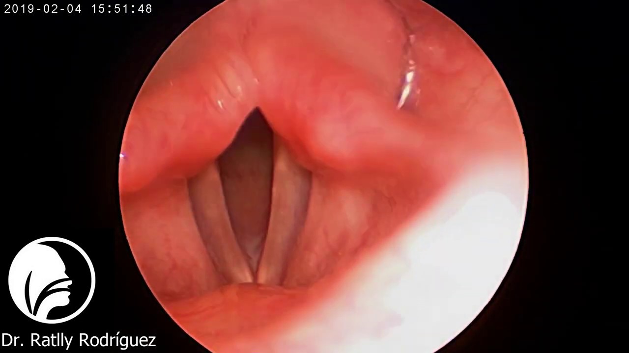 Differenza Tra Laringoscopia E Fibrolaringoscopia Laringoscopia normal con lente de 70° - YouTube