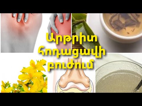 Video: Ո՞ւմ է ազդում ռևմատոիդ արթրիտը: