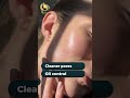 Carbon Laser Facial at RootMate Clinic – Deep Skin Detox, Oil Control & Instant Glow Results ✨#viral