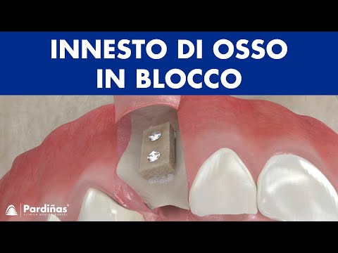 Innesto di osso in blocco ©