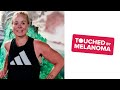 Jen's Story - Touched By Melanoma Stages 3 & 4