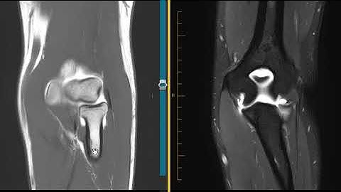 UCL tear from the sublime tubercle