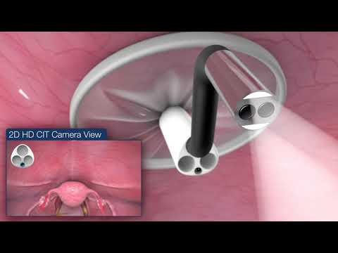 DD_Titan Medical Single Port Robotic System