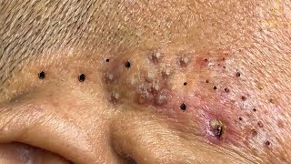 Remove Blackheads and Pimples Popping At HT Spa #38