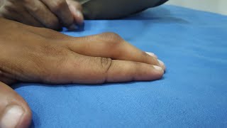 Middle finger in ligament injury#ligament screenshot 4