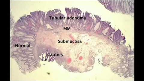 Underwater EMR  of a flat non granular type LST SD