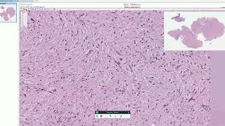 Rosenthal fibers in Pilocytic Astrocytoma  - Adventures in Neuropathology
