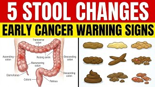 5 Stool Changes That Could Be Early Cancer Warning Signs | Dr. Michael Kent
