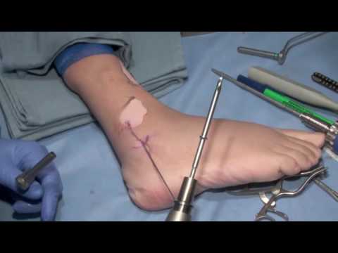Video: Gdje se nalazi lateralni malleolus?