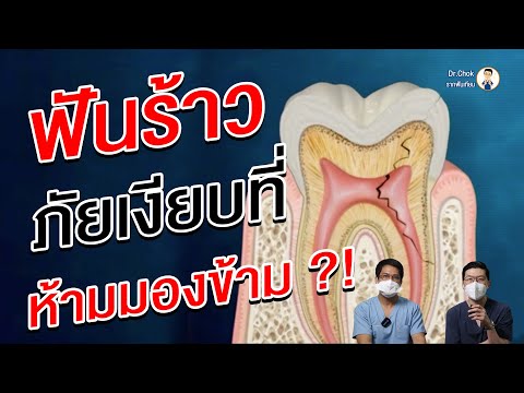 ฟันร้าวอันตรายแค่ไหน ? แล้วจะรักษาอย่างไร ? | คลายปัญหา รากฟันเทียม กับ หมอโชค