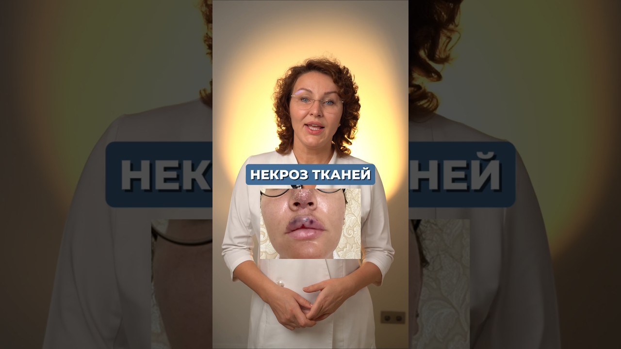 НЕКРОЗ ТКАНЕЙ. КАК ПОНЯТЬ? #инъекционнаякосметология #косметолог #ботокс
