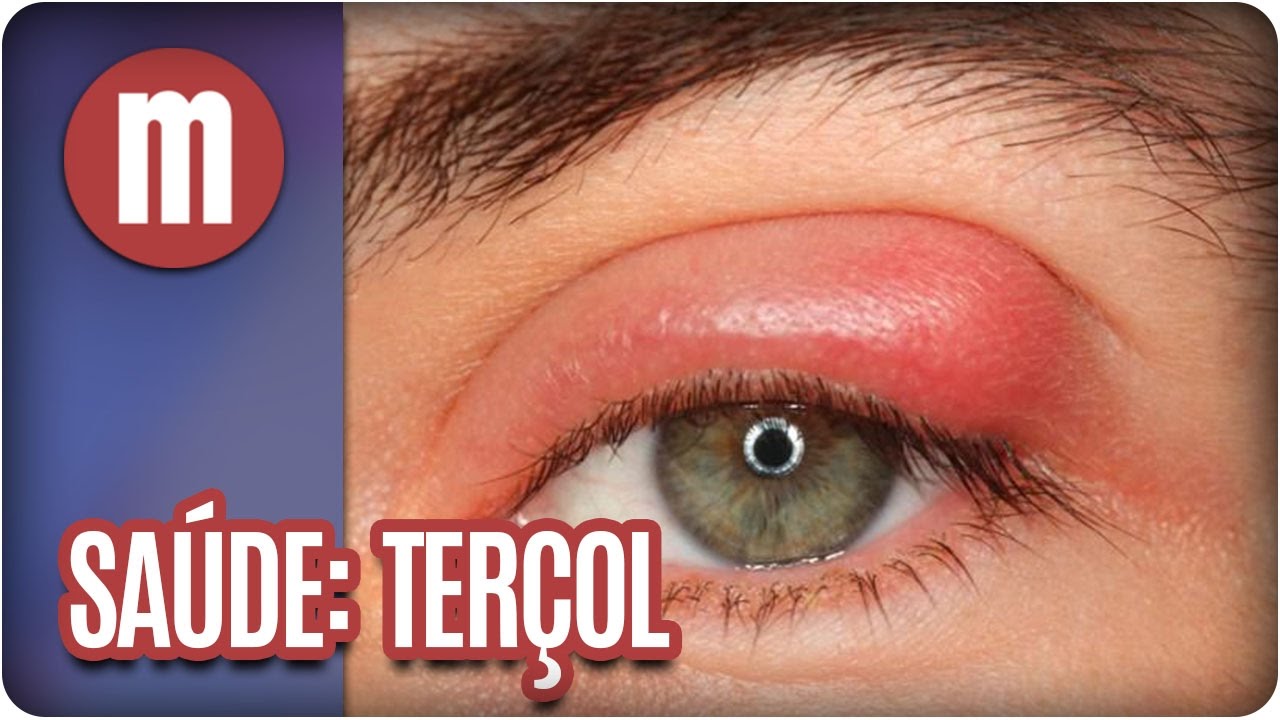 Terçol: 5 Dicas para Aliviar - Clínica de Olhos Fernandes