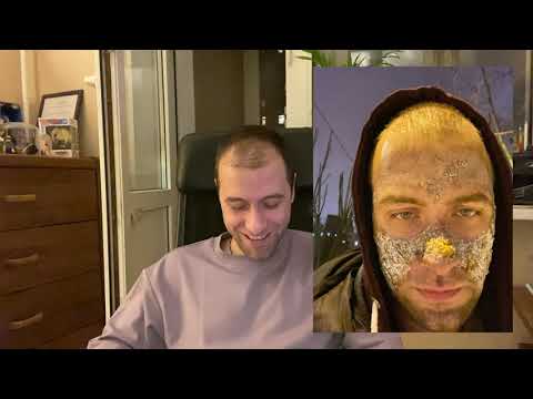 Лазерная CO2 шлифовка лица | Полный процесс реабилитации | До и После | А стоит оно того?