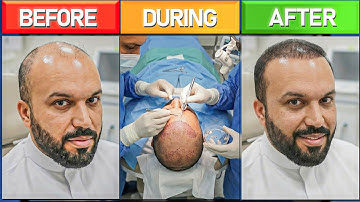 The Truth About My Hair Transplant 🏥💉 Full Transformation Experience