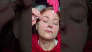 Patient Gets Daxxify - the NEW Neuromodulator | Dr. David P Rapaport NYC