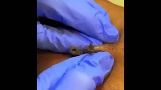 Oddly Satisfying Video 10 Blackhead Removal Zits Button Popping Feet Skin Cleaning