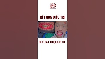 Điều Trị Khớp Cắn Ngược (Răng Móm)  Hình Ảnh Thực Tế  Sau Điều Trị Răng Móm - Niềng Răng#shorts