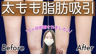 脂肪吸引 Youtube 脂肪吸引 Youtube