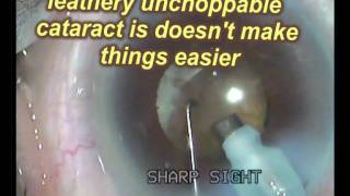 Supra hard cataract with fibrosed capsule. OPL competition video.mpg